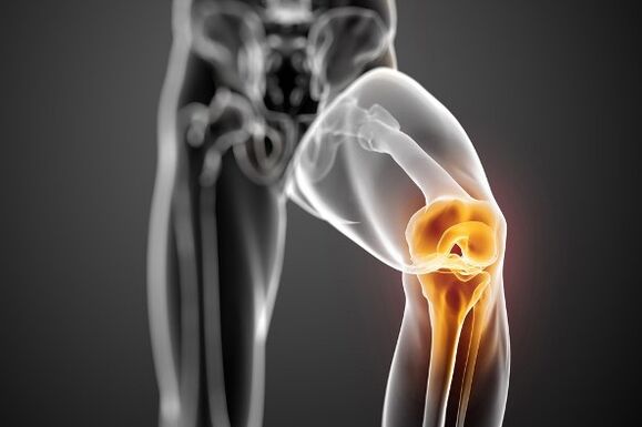 Arthroza kolenskega sklepa