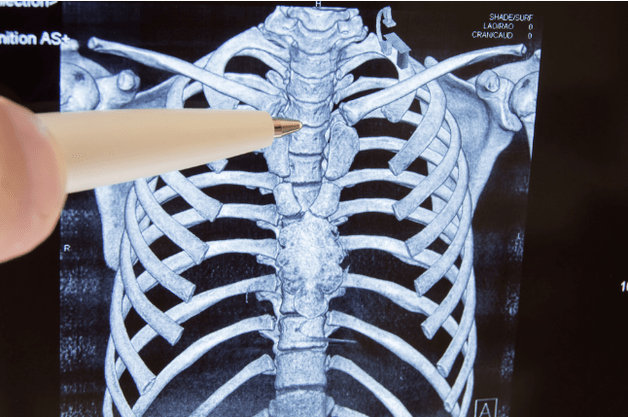 Osteohondroza