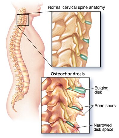 Osteohondroza materničnega vratu