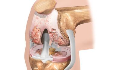 Arthroza kolenskega sklepa