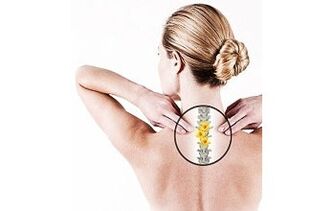 cervikalna osteohondroza pri ženskah