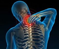 osteohondroza vratne hrbtenice