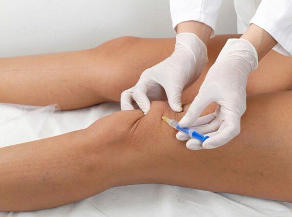 intraartikularna injekcija za artrozo kolena