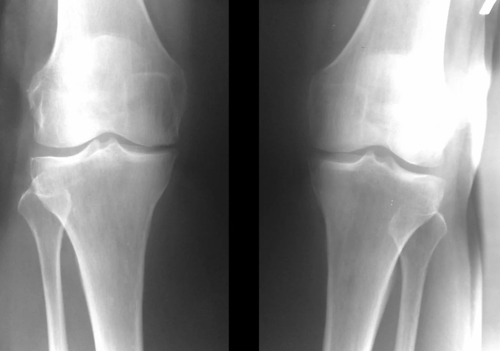 diagnoza artroze kolenskega sklepa